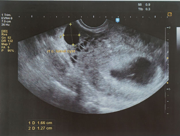 Hình ảnh siêu âm thai nhi 7 tuần tuổi
