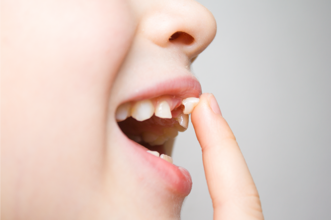 Thông thường, các răng sữa sẽ tự rụng và nhường chỗ cho răng vĩnh viễn mọc lên