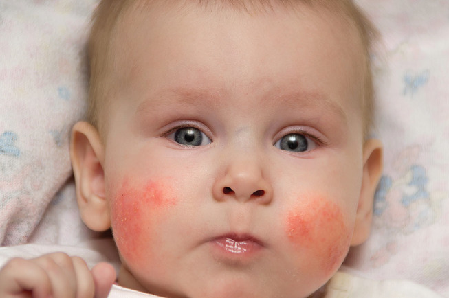 Xịt kháng khuẩn cho trẻ sơ sinh Skin Expert giúp kháng khuẩn, xử lý nhiều loại vết thương