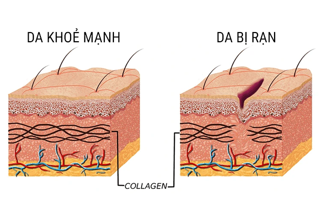 Rạn da là tình trạng xuất hiện những vết nhỏ, dài lan rộng trên bề mặt da
