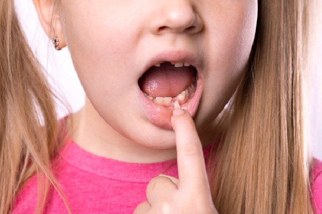 Sún răng là hiện tượng hay gặp ở trẻ 1 – 3 tuổi. Tuy không gây cảm giác đau nhức cho bé và chỗ bị sún thường nông.