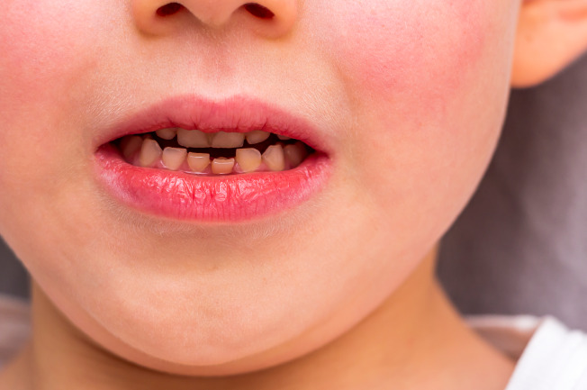 Nguyên nhân chủ yếu là do các bé chưa được vệ sinh răng miệng thường xuyên và đúng cách.