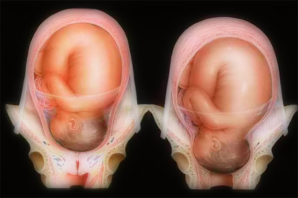 Cổ tử cung từ đóng kín đến mở hoàn toàn 10cm để đầu em bé có thể lọt qua khỏi tử cung