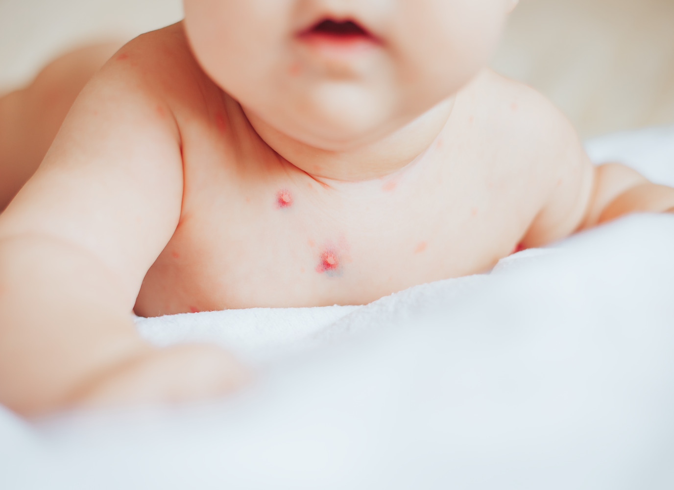 Bệnh thủy đậu ở trẻ em: triệu chứng và cách chữa trị