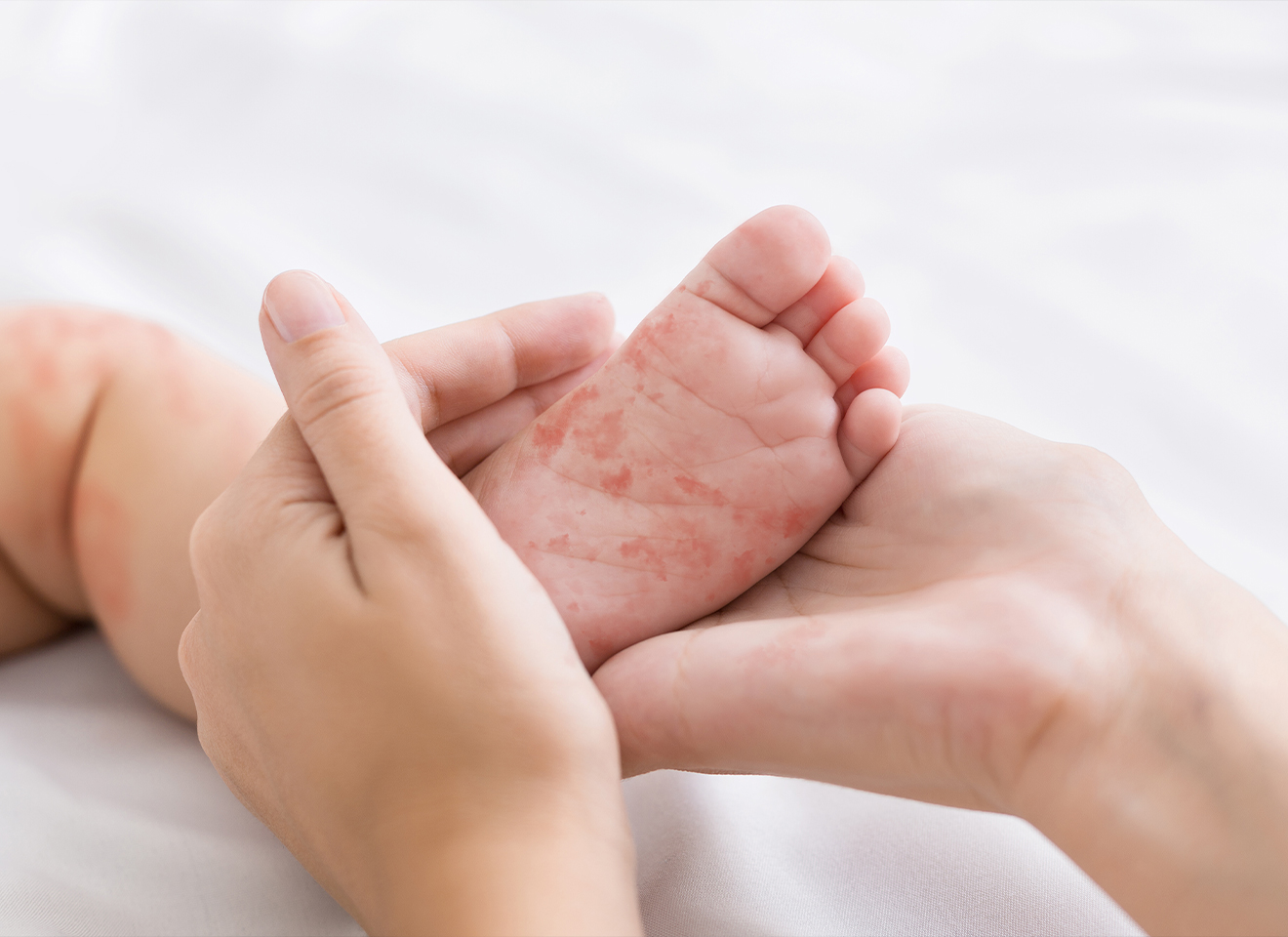 Trẻ sơ sinh bị mẩn đỏ – hiểu đúng để chữa trị đúng