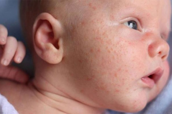 Bé 1 tuổi bị nổi mẩn đỏ ở mặt | Nguyên nhân và cách xử lý