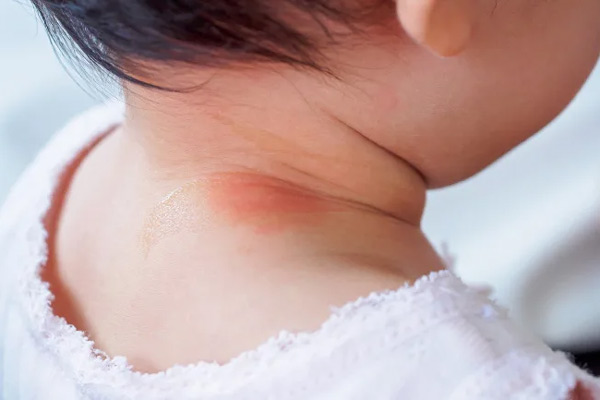Nguyên nhân bé bị mẩn đỏ ở cổ và cách chữa hiệu quả