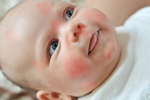6 cách xử lý khoa học khi bé bị mẩn đỏ quanh mắt tại nhà
