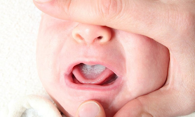 Nấm lưỡi gây đau và mất vị giác nên bé bú ít hơn