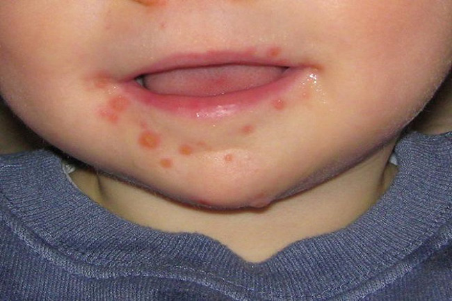 Herpes ở trẻ nhỏ thường xuất hiện quanh miệng, môi hoặc mắt.
