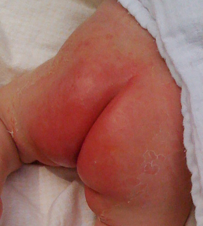 Với hăm tã cấp độ 5, vùng da của bé bị sưng phù nề kèm lở loét rất đau và ngứa. Mẹ áp dụng cách chăm sóc đúng bé có thể khỏi dao động từ 2 tuần - 1 tháng. 