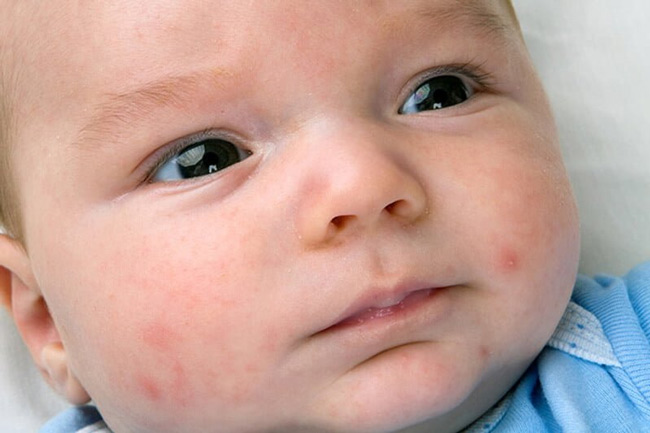 Hầu hết các vết mẩn đỏ ở mặt không nguy hiểm với bé