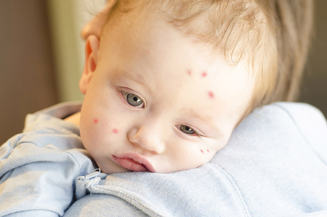 Mẹ lưu ý dùng màn chống muỗi cho bé mỗi khi bé ngủ. 