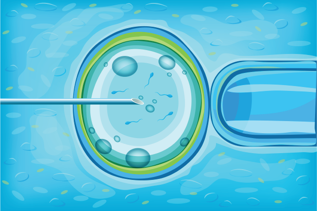 IUI là phương pháp thực hiện bơm tinh trùng vào buồng trứng của mẹ bằng ống thông nhỏ, mềm