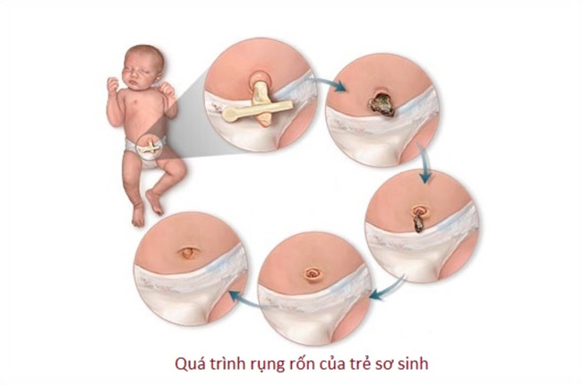 Quá trình rụng rốn của bé sơ sinh