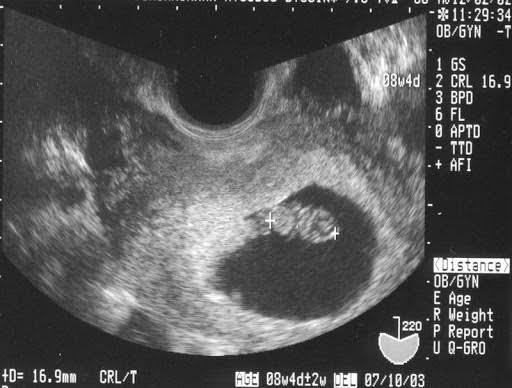 Hình ảnh thai nhi ở tuần thứ 6