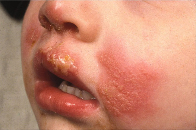 Chàm bội nhiễm gây mẩn đỏ thành từng mảng  ở trẻ nhỏ