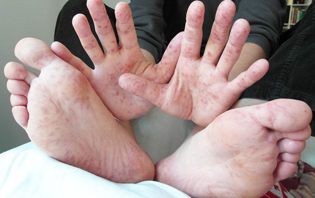 Mẩn đỏ do tay chân miệng xuất hiện ở ở cả bàn tay, chân và miệng