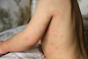 6 nguyên nhân bé bị nổi mẩn đỏ không sốt và cách xử lý