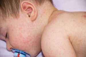 Bé 3 tuổi bị nổi mẩn đỏ – Nguyên nhân, biểu hiện và cách xử lý
