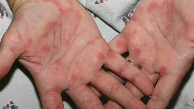 Bé nổi mẩn đỏ ở lòng bàn tay do Lupus ban đỏ hệ thống