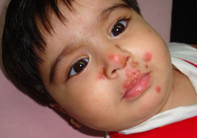 Bệnh chốc lở là một nguyên nhân khiến bé nổi mẩn đỏ quanh miệng