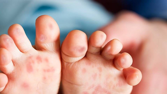 Bệnh tay chân miệng có thể khiến bé bị mẩn đỏ ngứa khó chịu