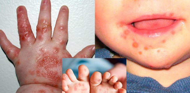 Bé nổi mẩn đỏ xung quanh miệng, lòng bàn tay, chân kèm theo sốt cao là biểu hiện của bệnh tay chân miệng.