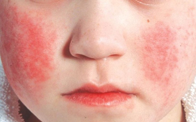 Bé ban đỏ nhiễm độc có biểu hiện điển hình là các vết mẩn đỏ đối diện hai bên má