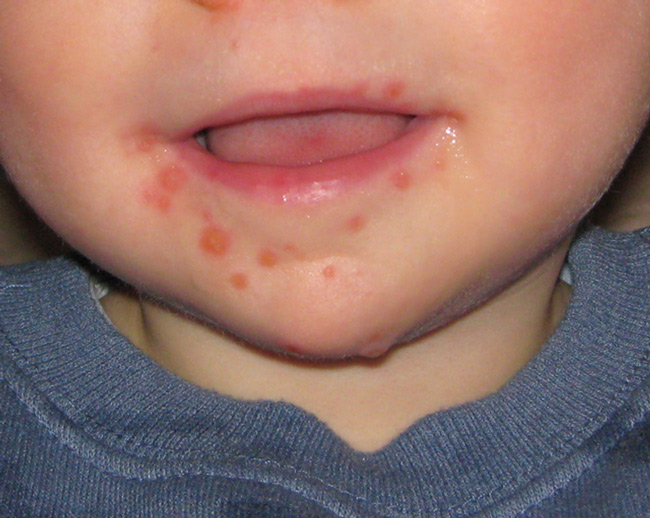 Bé 5 tháng tuổi bắt đầu mọc răng và bị nổi mẩn quanh miệng