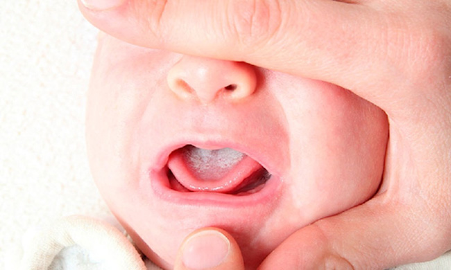 Rơ lưỡi cho bé thường xuyên khi bé bị mẩn đỏ do nấm mẹ nhé!