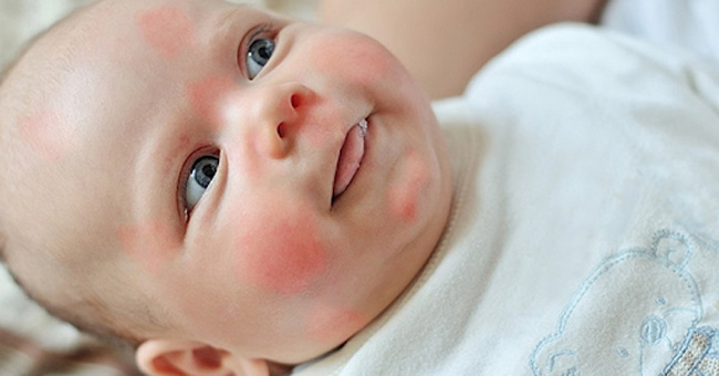 Dị ứng khiến bé bị nổi mẩn đỏ ở đầu và rải rác khắp người 