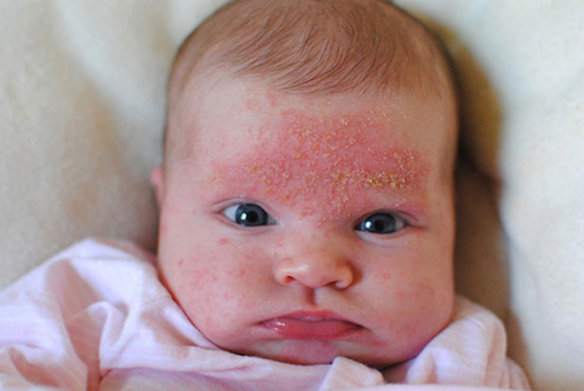 Viêm da tiết bã nhờn gây mẩn đỏ ở đầu cho bé 