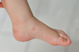 6 nguyên nhân khiến bé bị mẩn đỏ ở chân và cách xử lý