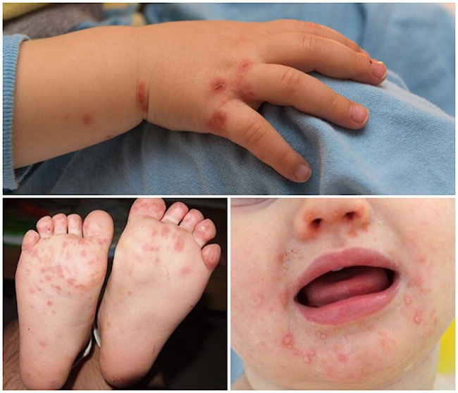 Bệnh tay chân miệng (HFMD- Hand, foot and mouth disease) là bệnh lý nguy hiểm do virus gây ra