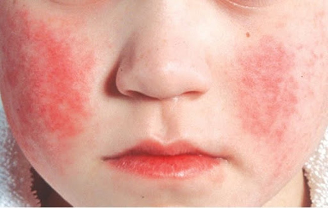 Vết ban đỏ thành đám đối xứng 2 má, giống như vết tát má là dấu hiệu đặc trưng của bệnh ban đỏ nhiễm khuẩn.