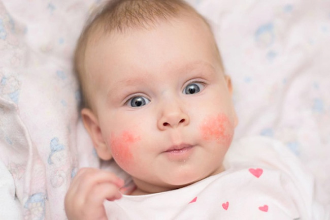 Viêm da tiếp xúc là một nguyên nhân khiến bé bị nổi mẩn đỏ.