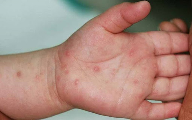Những nốt mẩn đỏ, bọng nước trên tay là một trong những dấu hiệu đặc trưng của bệnh tay chân miệng ở bé