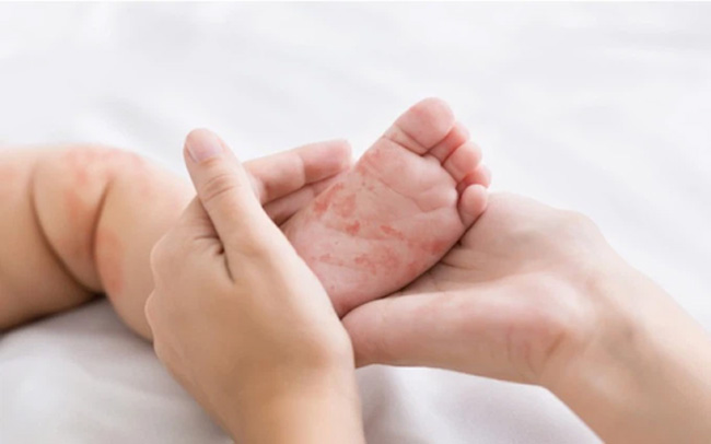 Bệnh sởi là một bệnh truyền nhiễm phổ biến ở bé sơ sinh, gây mẩn đỏ ở chân và khaows người 