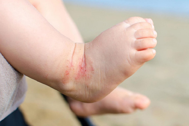 Bé bị mẩn đỏ ở chân có thể do bệnh tổ đỉa