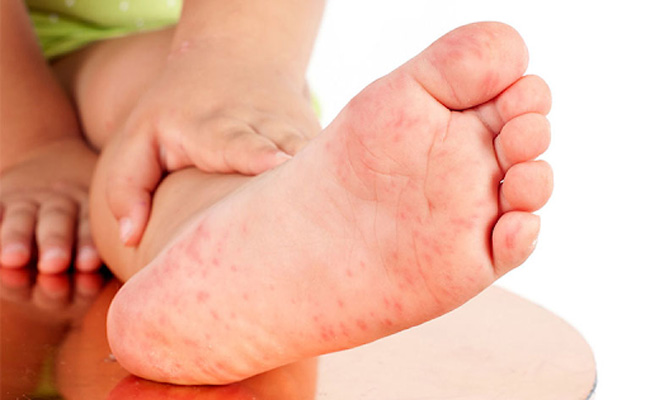 Bé bị mẩn đỏ ở chân có thể do những nguyên nhân nào?