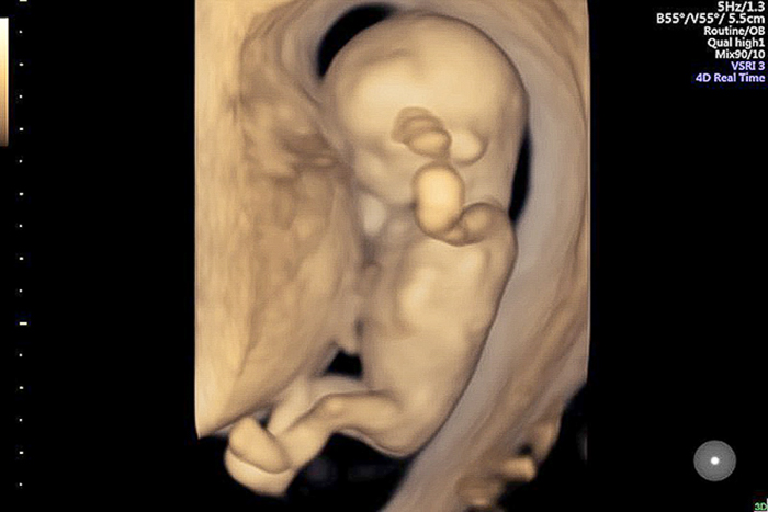 Mẹ sẽ nhìn thấy chuyển động của bé yêu khi siêu âm thai 3 tháng đầu bằng loại hình 4D nhé